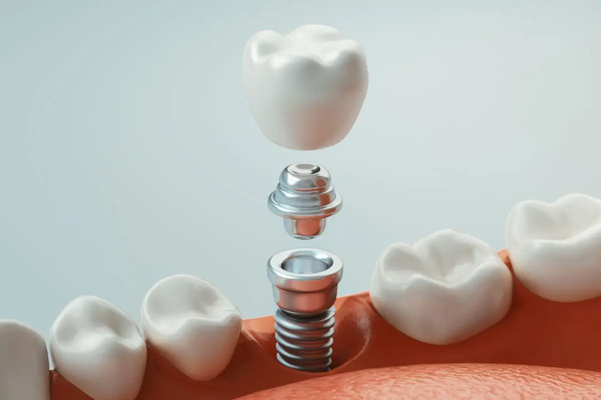 ¿Cuánto duran los implantes dentales? | Clínica Dental Luciano Badanelli