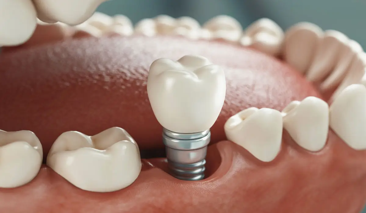 Los implantes dentales... ¿son para siempre? | Clínica Dental Luciano Badanelli