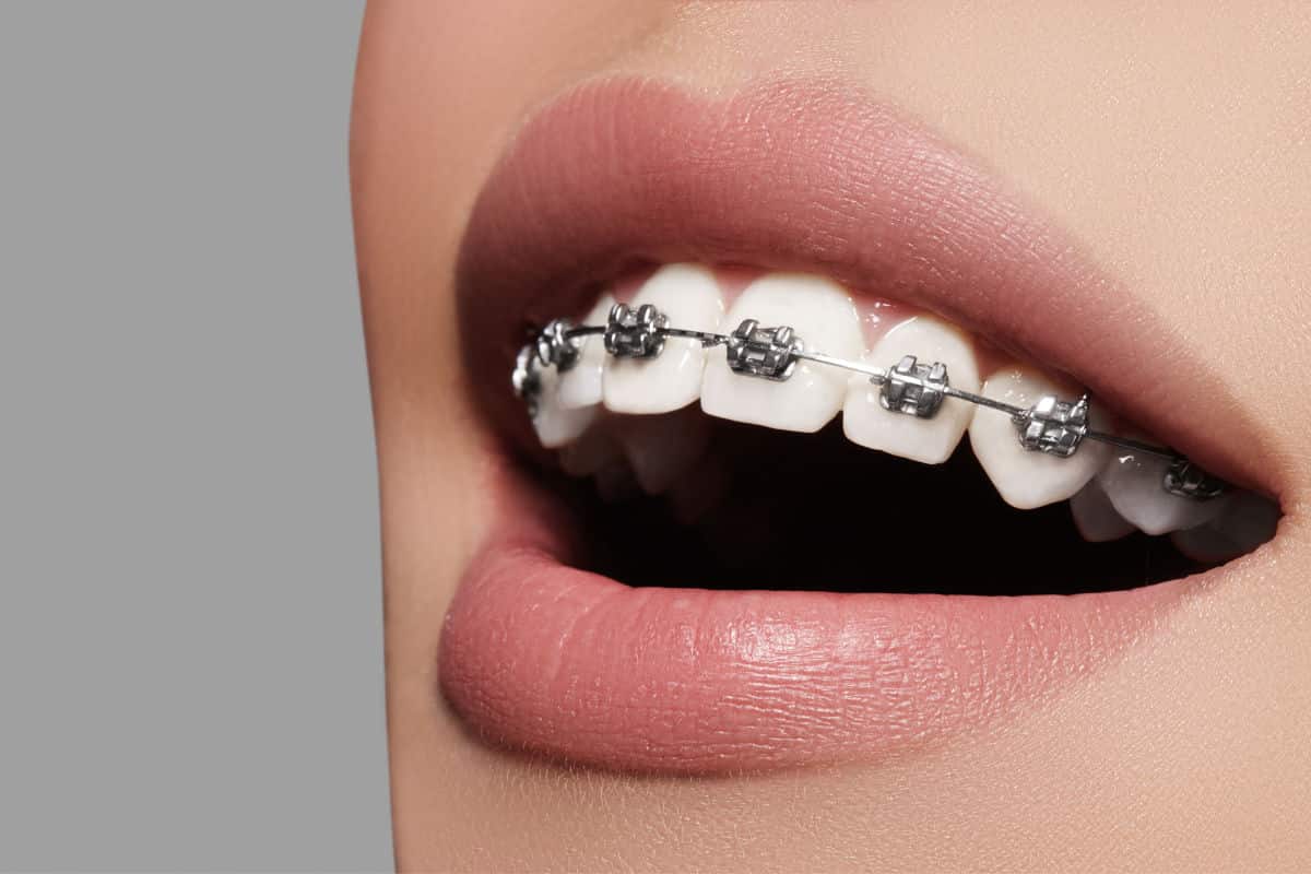Ortodoncia ¿qué tipos hay y cuándo es necesaria?