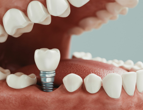 Cirugía con implantes dentales. Métodos y soluciones
