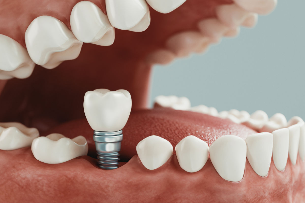 Cirugía con implantes dentales. Métodos y soluciones