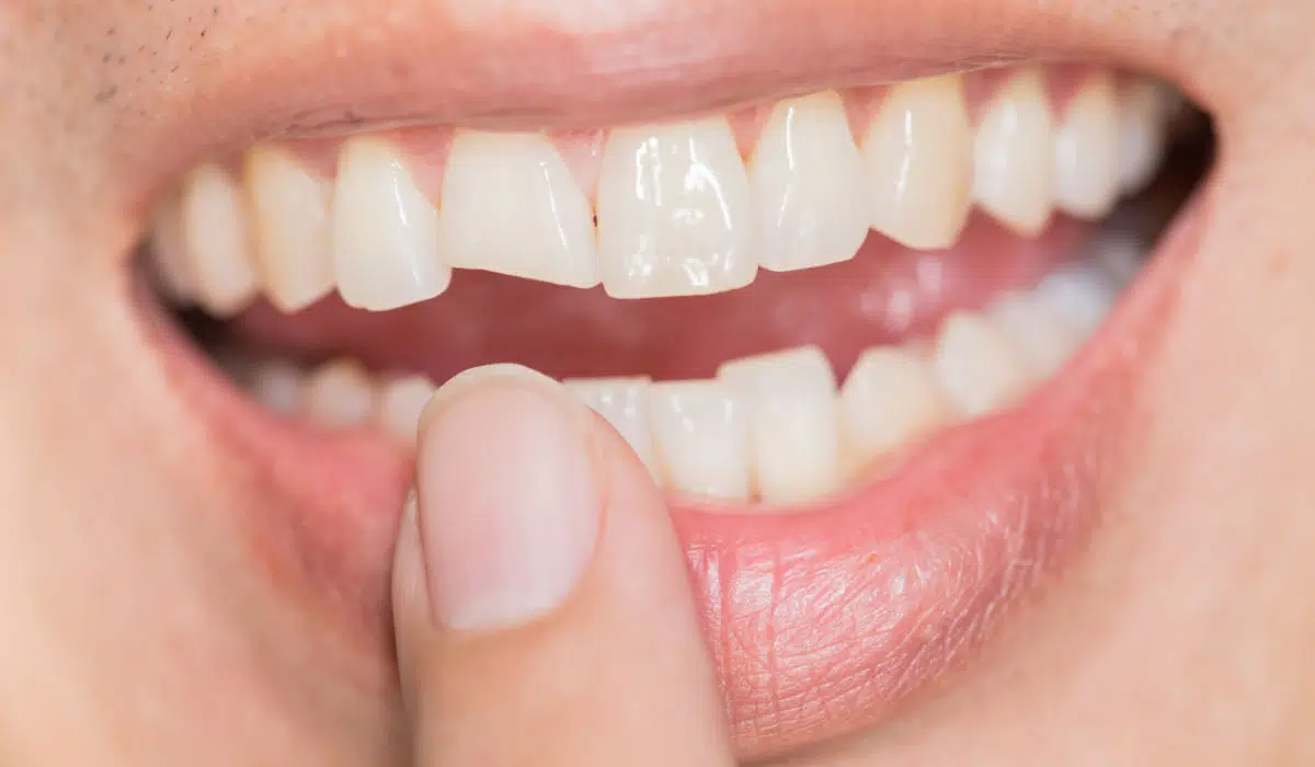 ¿Qué ocurre si te rompes un diente y qué tipos de fracturas dentales hay?